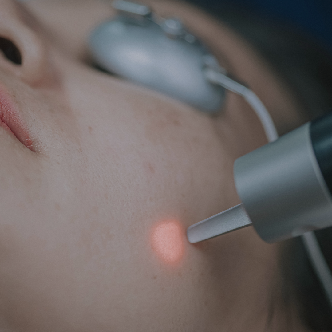 Láser Bioestimulación Facial 1 Sesión